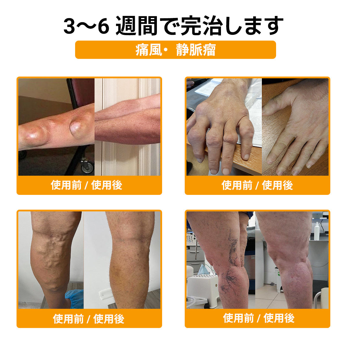 ZUWIAY® ハチ毒配合 痛み緩和・骨の治癒クリーム 🎊🎊（特に高齢者向け）